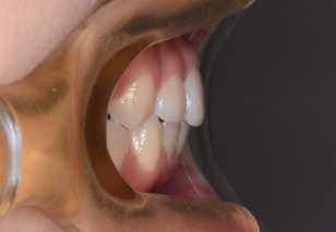 上顎第1小臼歯便宜抜歯にて治療を行なった重度の骨格性上顎前突症例。