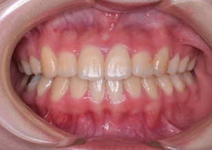 小臼歯便宜抜歯にて治療を行なった叢生（ガタガタの歯並び）症例。