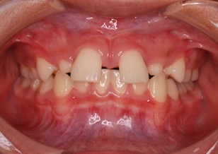 上顎前歯部に先天欠如歯を認めるスペースアーチ（隙っ歯）症例。