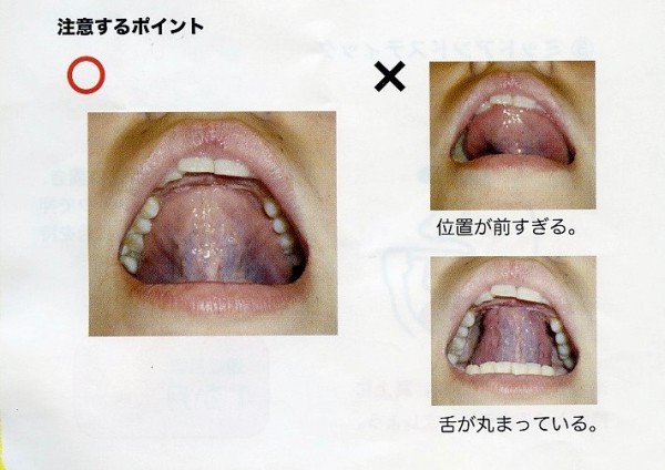 舌 で 歯 を 押す 癖 治す 大人