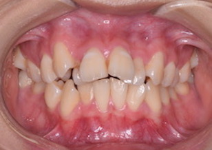 上顎前歯の前突をともなう叢生症例。