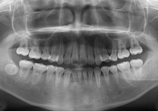 上下顎歯列に3歯の埋伏歯を認める治験例。