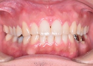 過蓋咬合をともなう上顎歯列のスペースアーチ（隙っ歯）症例。