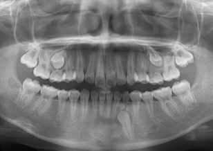 上下顎歯列に3歯の埋伏歯を認める治験例。