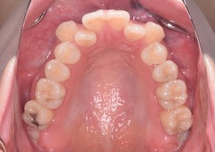 リンガルブラケットを使用して治療を行なった成人の叢生症例。