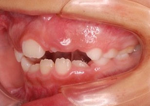早期治療により非抜歯にて矯正治療が完了した叢生をともなう開咬症例。