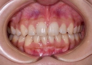 小臼歯便宜抜歯にて矯正治療を行なった成人の叢生症例。