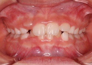 早期治療の効果により非抜歯にて治療が完了した叢生（ガタガタの歯並び）治療例。