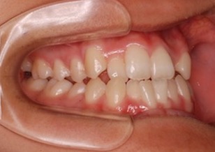 変則的な便宜抜歯にて治療を行なった叢生症例。