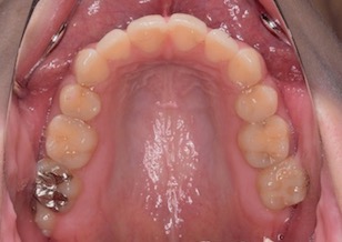 リンガルブラケットを用いて小臼歯便宜抜歯にて治療を行なった叢生（ガタガタの歯並び）症例。