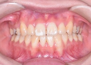 先天欠如歯をともなう成人の叢生（ガタガタの歯並び）症例。