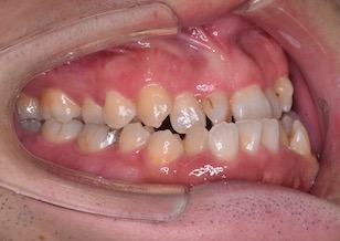 顎変形症に起因する不正咬合にて外科的矯正治療を行なった症例。