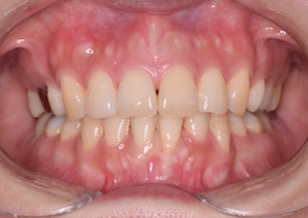 リンガルブラケットにて治療を行った上下顎前歯部に叢生をともなう上顎前突症例。