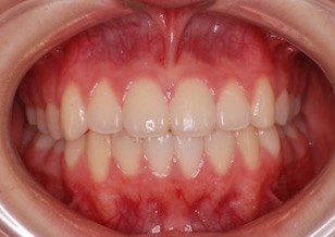 早期治療の効果にて永久歯非抜歯にて矯正治療が完了できた叢生症例。