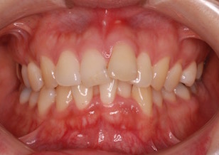 リンガルブラケットにて治療を行った上下顎前歯部に叢生をともなう上顎前突症例。