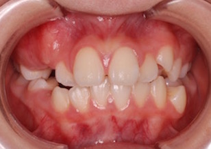 早期治療の効果にて永久歯非抜歯にて矯正治療が完了できた叢生症例。