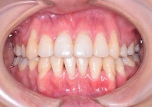 歯肉退縮が認められる叢生をともなう成人の開咬症例。