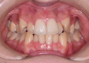 上下顎第１小臼歯抜歯にて治療を行なった叢生症例。