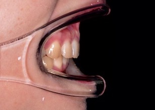 過蓋咬合をともなう重度の上顎前突症。