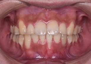 歯肉退縮をともなう成人の叢生症例。