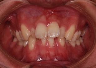 歯肉退縮をともなう成人の叢生症例。