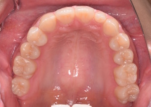 矯正用インプラントアンカー（ミニスクリュー）を利用して大臼歯の欠損スペースを閉鎖した症例