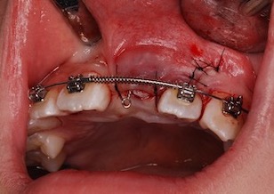 埋伏歯（上顎中切歯）の開窓・牽引治療例。