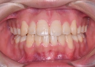 上下顎歯列に重度の叢生をともなう開咬症例。