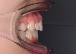 矯正用インプラントアンカーを用いて治療を行った叢生をともなう上顎前突症例。