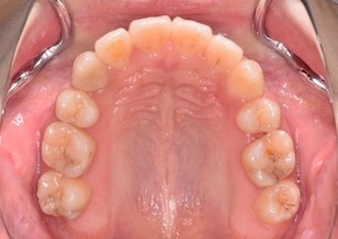 大臼歯欠損部位への第三大臼歯の移動を行なった叢生症例。