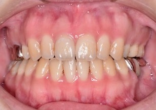 上顎第一小臼歯の便宜抜歯にて矯正治療を行なった重度の開咬症例。