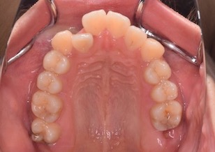 大臼歯欠損部位への第三大臼歯の移動を行なった叢生症例。