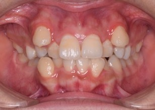 小臼歯便宜抜歯にて矯正治療を行なった重度の叢生症例。