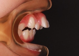 叢生をともなう上顎前突・前歯部開咬症例。