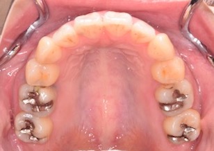 変則的な便宜抜歯にて矯正治療を行なった成人の叢生症例。