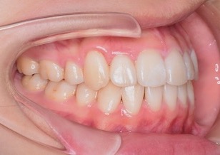 大臼歯部に交叉咬合を伴う重度の叢生(ガタガタの歯並び)症例。