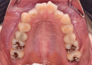 変則的な便宜抜歯にて矯正治療を行なった成人の叢生症例。
