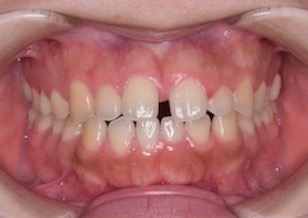 リンガルブラケットにて治療を行なった上下顎歯列のスペースアーチ(隙っ歯)症例。