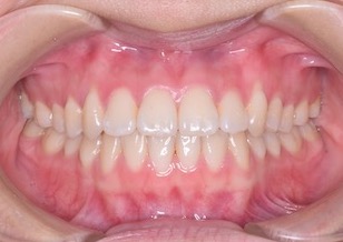 リンガルブラケットを用いて非抜歯にて治療を行った叢生(ガタガタの歯並び)をともなう開咬症例。