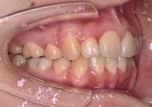 便宜抜歯にて矯正治療を行った成人の叢生症例。