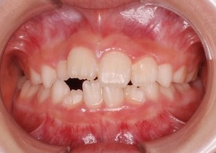 早期治療により非抜歯にて治療が完了できた小児の叢生(ガタガタの歯並び)症例。