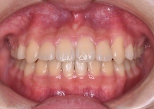 早期治療により非抜歯にて治療が完了した叢生(ガタガタの歯並び)症例。