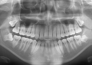 左右上顎埋伏犬歯（2本）の開窓・牽引症例。