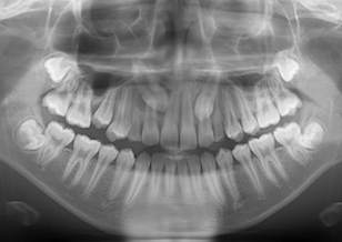 左右上顎埋伏犬歯（2本）の開窓・牽引症例。