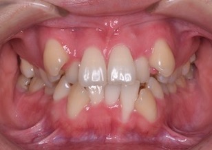 小臼歯便宜抜歯にて矯正治療を行った重度の叢生症例。