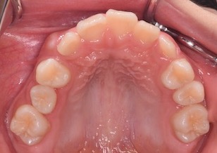 ペンデュラムアプライアンスにて上顎第1大臼歯の後方移動を行い、非抜歯にて矯正治療を行った叢生症例。