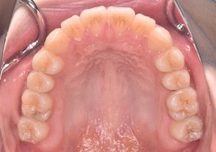 ペンデュラムアプライアンスにて上顎第1大臼歯の後方移動を行い、非抜歯にて矯正治療を行った叢生症例。