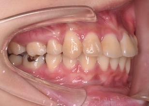 両側臼歯部に交叉咬合（すれ違い咬合）を有する過蓋咬合症例 。