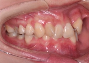 両側臼歯部に交叉咬合（すれ違い咬合）を有する過蓋咬合症例 。