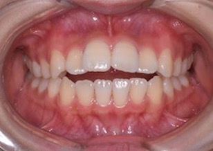 非抜歯にて矯正治療を行なった重度の開咬症例。
